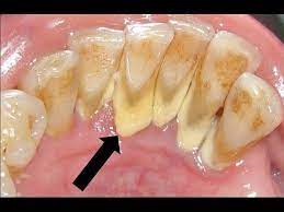 Aug 07, 2018 · here's a list of 14 best home remedies to get rid of cavities. Dental Cleaning 3 Best Teeth Plaque Removers Youtube Plaque Teeth Teeth Cleaning Deep Teeth Cleaning