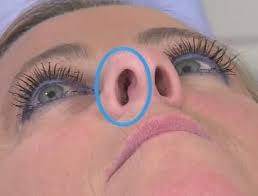 A deviated septum can often create negative effects on the sinuses, particularly the sinus ostium. How To Fix A Deviated Septum Without Surgery Find Alternatives Max Air Nose Cones Sinus Cones Official Site Ultimate Breathing Snoring Sinus Relief For The Sleep Of Your Dreams