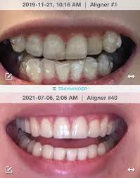 We bet you will put a smile on your face too!! Finally Done After Almost 2 Years I Never Thought My Smile Could Be So Wide And Not Flat Looking Truly One Of The Best Investments I Ever Made Invisalign