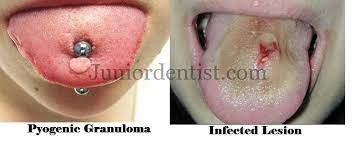 Complications And Risks Involved In Tongue Piercing