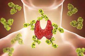 Hashimoto Symptome Die Typischen Anzeichen Erkennen Hashimoto Thyreoiditis