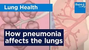 Image result for Pneumonia