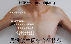 其胸壁之前面及側面 呈扁平狀或凹陷狀， 由於胸大肌之缺乏使得腋下皮膚褶突出，並在患處呈現 異形呼吸運動 (paradoxical respiratory motion)。 æ³¢å…°æ°ç»¼åˆå¾ Polandæ°ç»¼åˆå¾ è¯Šæ–­ä¸Žæ²»ç–—