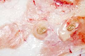 She developed an infestation which was treated locally. Botfly Facts And Tips For Removal