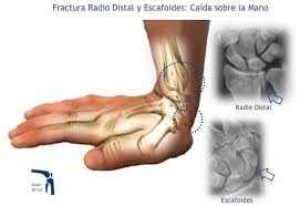 flexión dorsal traumática