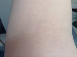 Pin On Patch Test