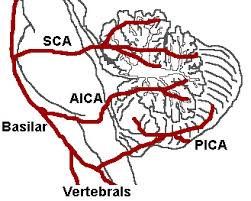 Cerebellar Stroke Syndrome Wikipedia