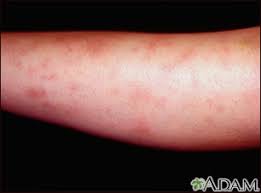 Image result for erythema nodosum