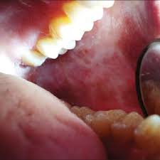 The anterior faucial pillars (afp) are bilaterally located on the oral side of the velum and form part of the soft palate. Soft Palate And Faucial Pillars Showing Redness Download Scientific Diagram