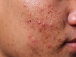 Apply the warm compress 10 to. Pimples That Are Ok To Pop