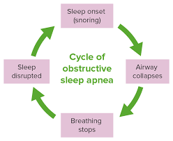 Image result for Obstructive Sleep Apnea