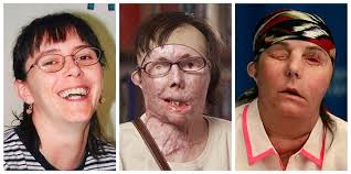 13 Before And After Photos Of People Who Had Facial Transplants