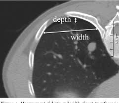 Risk factors for a pneumothorax. Figure 1 From Chest Computed Tomography Ct Immediately After Ct Guided Transthoracic Needle Aspiration Biopsy As A Predictor Of Overt Pneumothorax Semantic Scholar