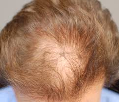 Shock loss from hair transplant can occur due to the following: Post Hair Transplant Hair Loss Shock Loss Wrassman M D Baldingblog