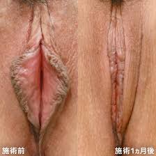 女性器 大阪の症例写真・画像・ビフォーアフター｜美容整形・美容外科のTAクリニックグループ
