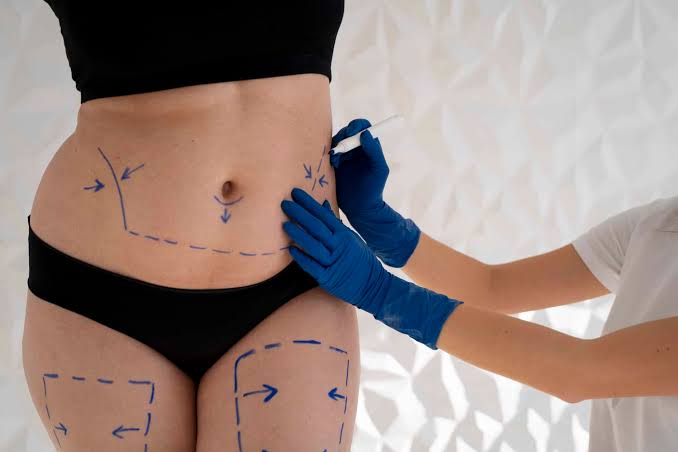 Belly Fat Removal with Liposuction | Advanced Liposuction at Dezire Clinic  - Dezire Clinic