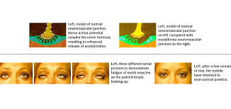 • a neuromuscular disorder characterized by. Myasthenia Gravis Bcm