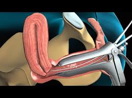 Nº casos % del total. Biopsia Endometrial Youtube