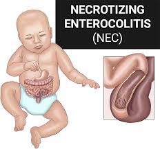 Image result for Necrotizing Enterocolitis