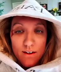 I'm glad to still be alive": Olympic silver party ends with a bad cab  accident