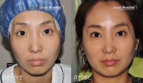 He then lifts the forehead skin to enhance the brow line and eliminate horizontal wrinkles. Upper Eye Lift Surgery