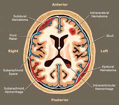 Hematoma Types In Brain Png 450 398 Subarachnoid Hemorrhage Epidural Hematoma Subdural Hematoma