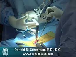 Pin On Lumbar Fusion Exercises And Info