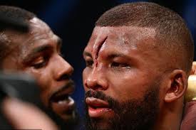 Dahi Dapat 25 Jahitan, Badou Jack: Saya Baik-baik Saja, Alhamdulillah