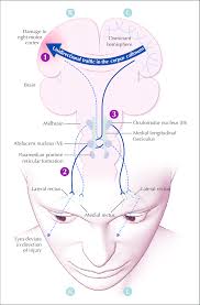 Conjugate Eye Deviation Resulting From A Right Sided Middle