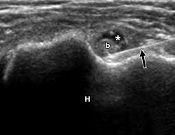 Image result for Biceps Tendon Injection