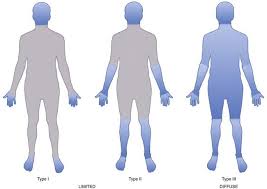 Image result for Systemic Sclerosis