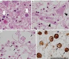 The nucleus & the nucleolus. Neurologic Impairment In Wilson Disease Dusek Annals Of Translational Medicine