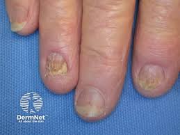 Image result for Onycholysis feet