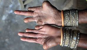 Image result for Leprosy