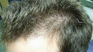 Do this regularly 3 times a week. Aloe Vera Treatment For Hair Loss And Re Growth Youtube