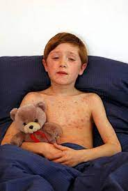 Schilddrusenuberfunktion Bei Kindern Symptome Und Ursachen