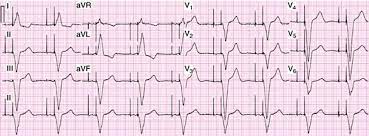 Vertical signals that represent the electrical activity of the pacemaker. A Dual Chamber Pacing Ecg Download Scientific Diagram