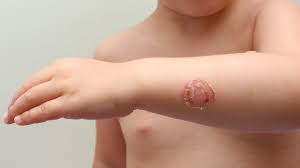 Itchy bumps on the arms is a condition in which small bumps develop on the skin and cause itching and irritation. Common Skin Rashes Everyday Health