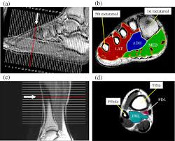 In conclusion, quantification of foot muscles enables an objective measure of motor dysfunction closely related to the severity of diabetic neuropathy. Mri With User Outlined Plantar Intrinsic And Extrinsic Muscles Group A Download Scientific Diagram