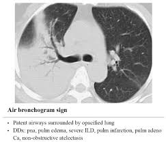 Image result for Air Bronchogram