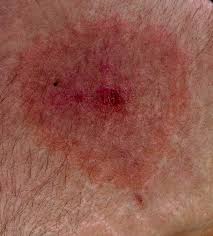 Bij een donkere huid kan de vlek gelig of blauwig zijn. Vlekvormige Huiduitslag Na Tekenbeet Kan Ook Lyme Zijn Actueel Ntvt