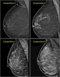 May 27, 2021 · the mammogram process takes about 15 minutes, and people should expect their results within 2 weeks. Bi Rads 3 Screening Mammogram Novocom Top