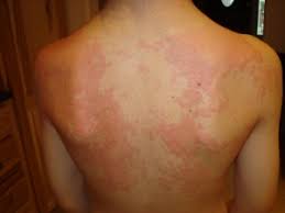Experiencing an allergic reaction to a vaccine is not uncommon, and independent scientists stressed that there was no need for immediate alarm. Our Story Of Food Allergies Allergicchild