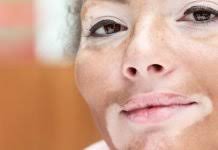 Optimal Use of Crisaborole in Atopic Dermatitis