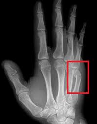 Image result for Hand Fracture