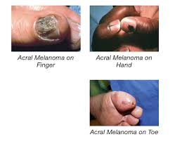 Image result for Acral lentiginous melanoma nail