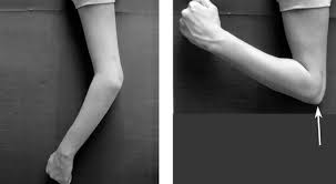 So i managed to break my wrist playing football last thursday, bad times! Elbow Olecranon Fractures Orthoinfo Aaos