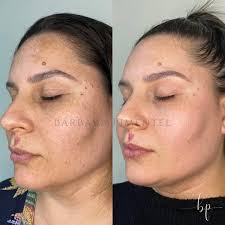 PEELING CLAREADOR DE MANCHAS Em apenas 1 sessão, esse rosto está totalmente  renovado 😍🙌🏻 Podemos tratar com eficiência e segurança, manchas que  tanto incomodam. Além de clarear, ele uniformiza e trás uma