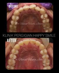 Pengalaman scaling (penskaleran) atau cuci gigi di klinik kerajaan. Klinik Pergigian Happy Smile Home Facebook