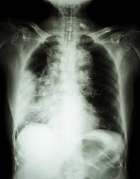 Secondary spontaneous pneumothorax is caused by underlying lung disease such as lung cancer, lung abscesses, heartworm disease, inflammatory airway disease, allergic bronchitis, tracheal rupture, foreign body migration, severe pneumonia, lung worms or flukes or lung nodules caused by fungal infection. 8 227 Lung Cancer Photos Free Royalty Free Stock Photos From Dreamstime